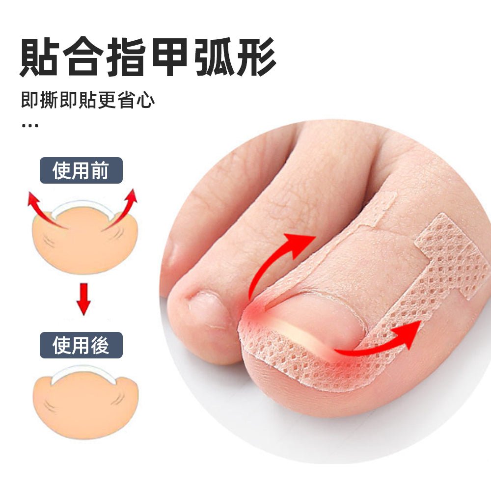 U型正甲貼片|溫和物理矯正,舒緩嵌甲不適