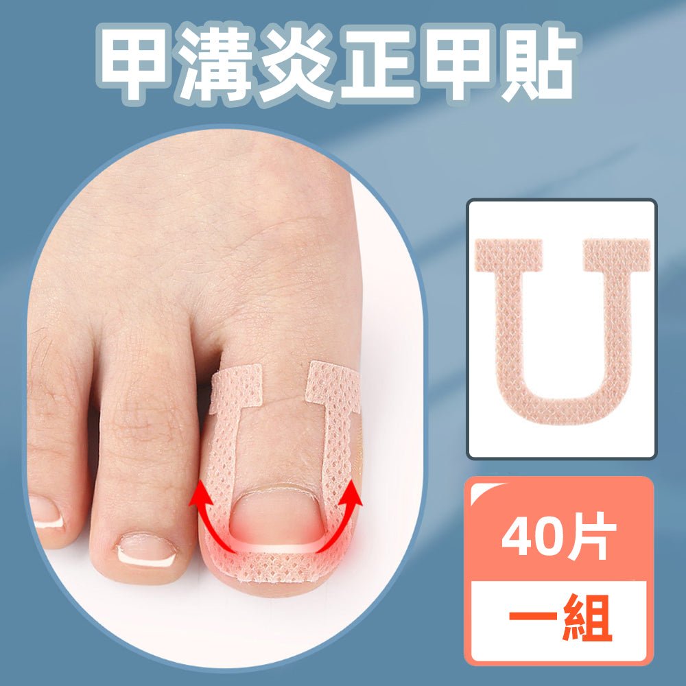 U型正甲貼片|溫和物理矯正,舒緩嵌甲不適