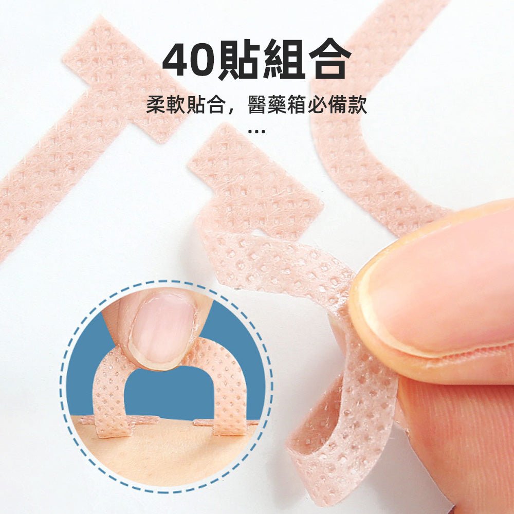 U型正甲貼片|溫和物理矯正,舒緩嵌甲不適
