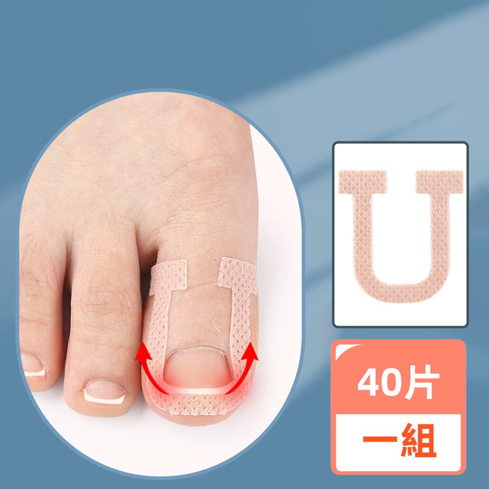 U型正甲貼片｜溫和物理矯正，舒緩嵌甲不適