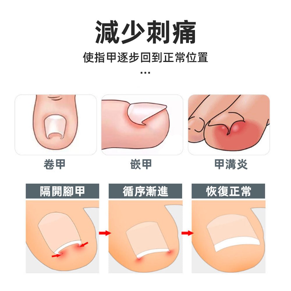 U型正甲貼片｜溫和物理矯正，舒緩嵌甲不適