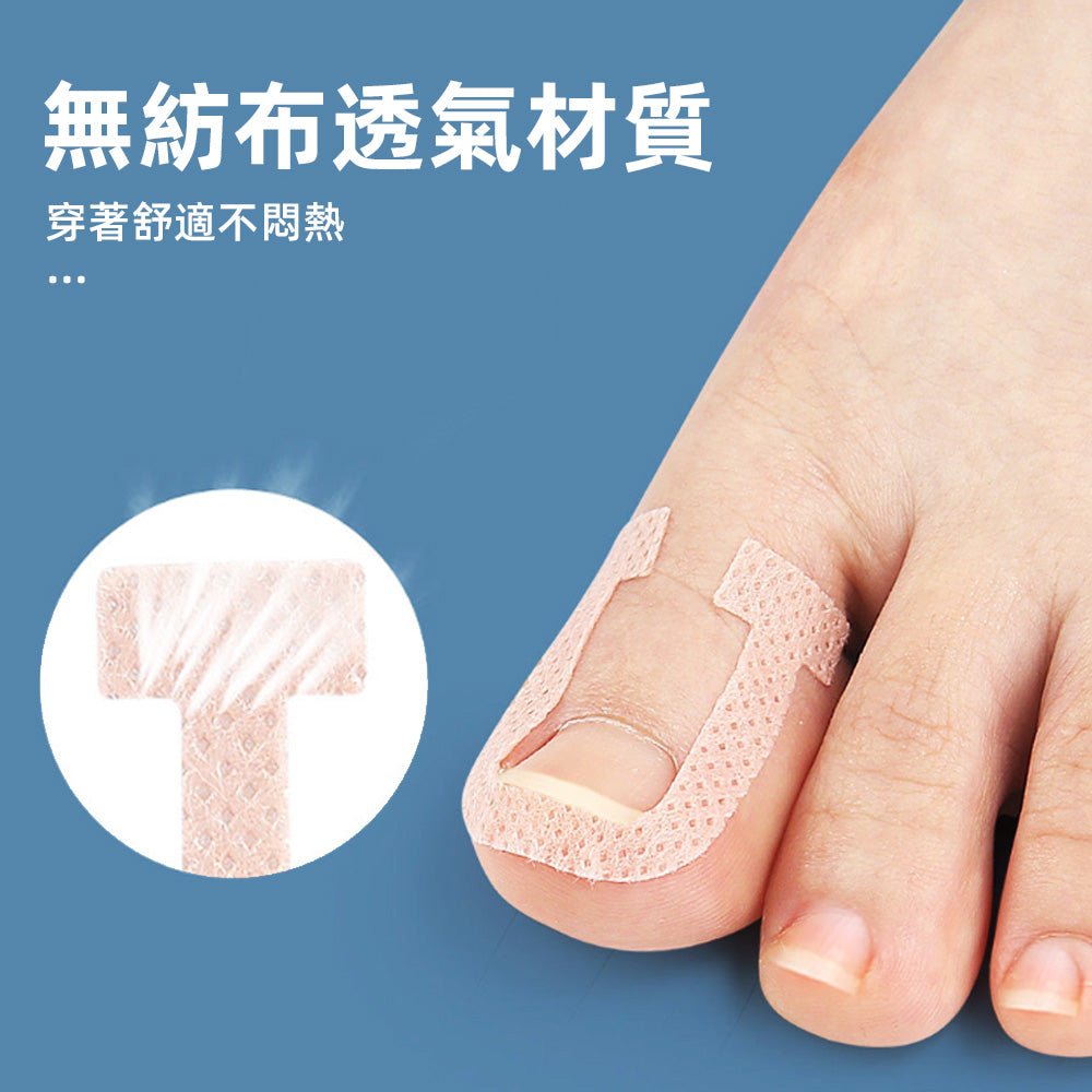 U型正甲貼片｜溫和物理矯正，舒緩嵌甲不適